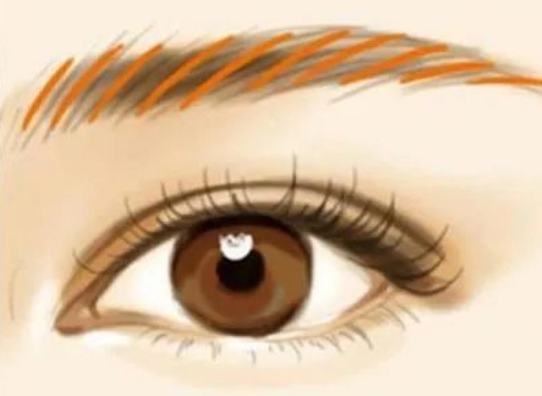 Adakah penyingkiran laser microblading (penyingkiran tatu kening) meninggalkan parut?